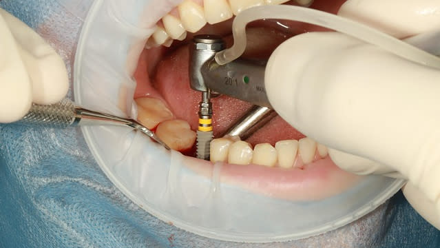 A Q&A With Spotimplant, a Dental Implantology AI