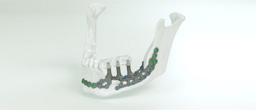 Coming Soon: More Support, Same Precision — IPS® Preprosthetic Evolved