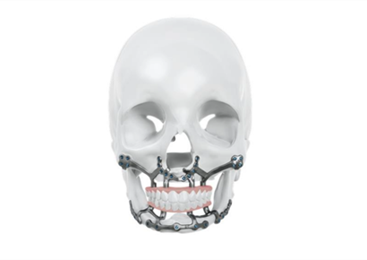 IPS® Preprosthetic: Expanding Treatment Options for Severe Jaw Atrophy