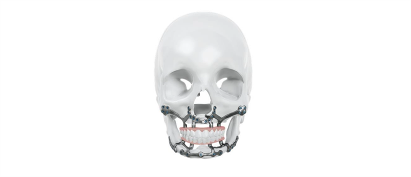 IPS® Preprosthetic: Expanding Treatment Options for Severe Jaw Atrophy