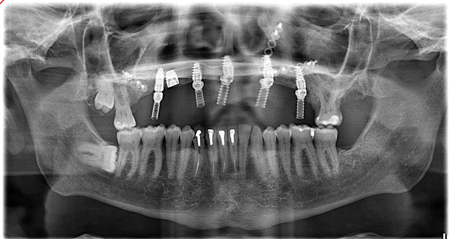 Panoramic X‑ray illustrating upper‑jaw reconstruction supported by multiple implants and prior surgical hardware.